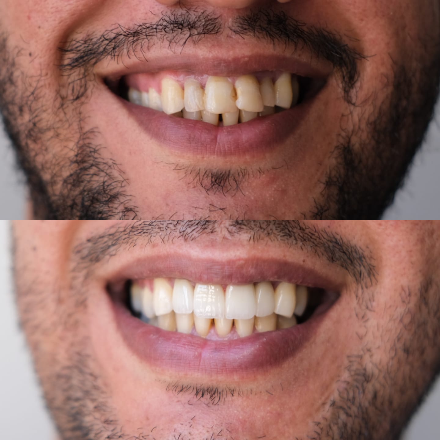 Sourire avant et après traitement