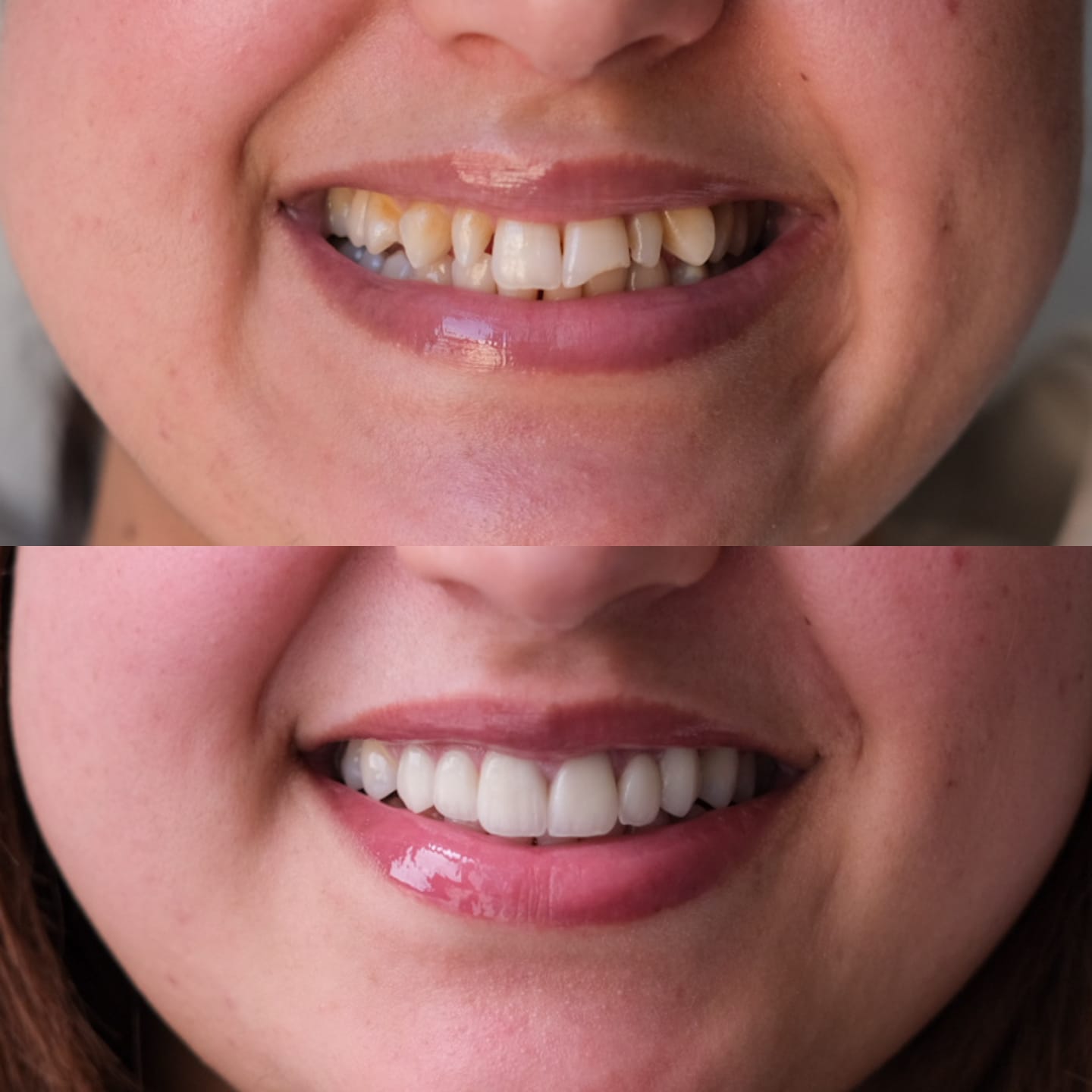 Sourire avant et après traitement