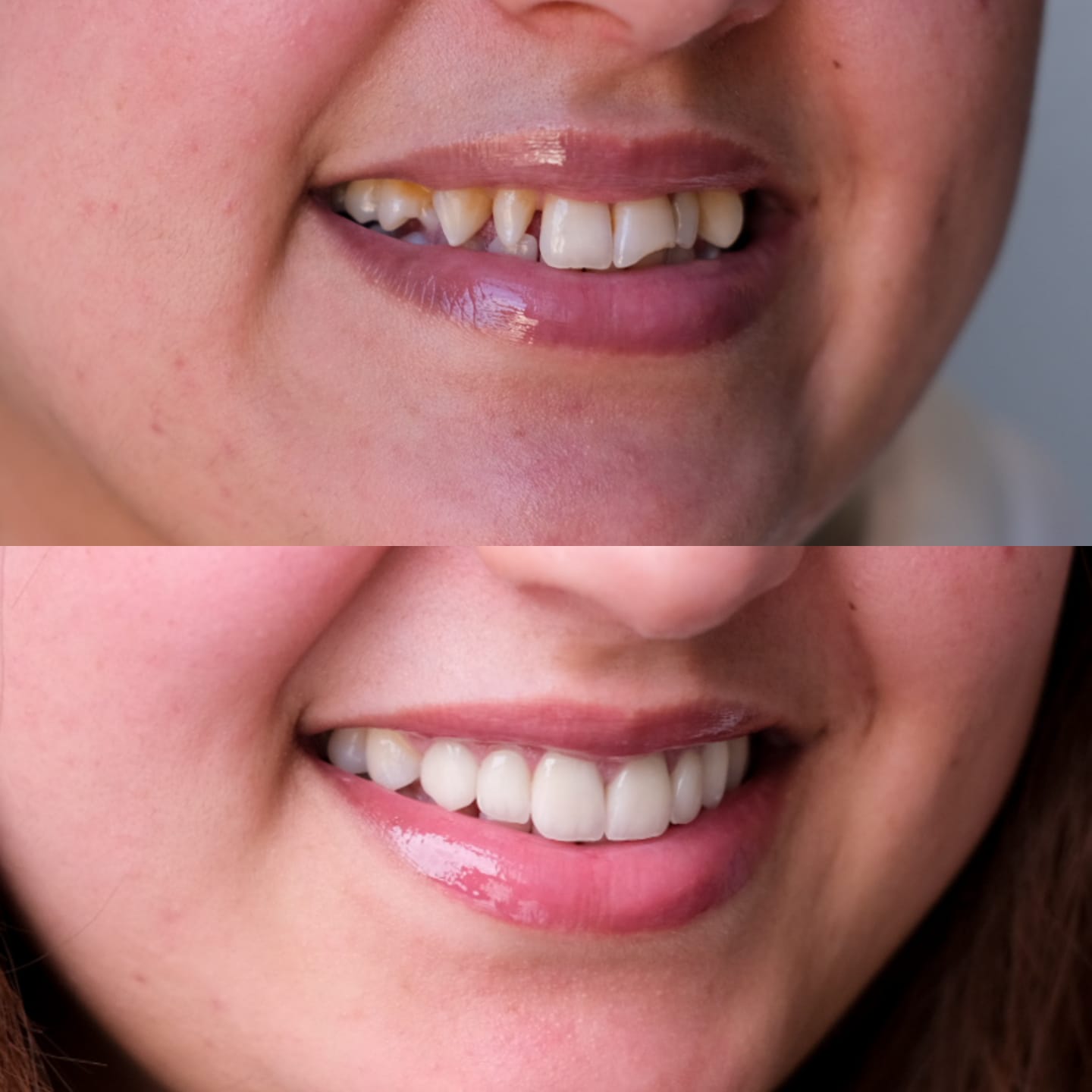 Sourire avant et après traitement