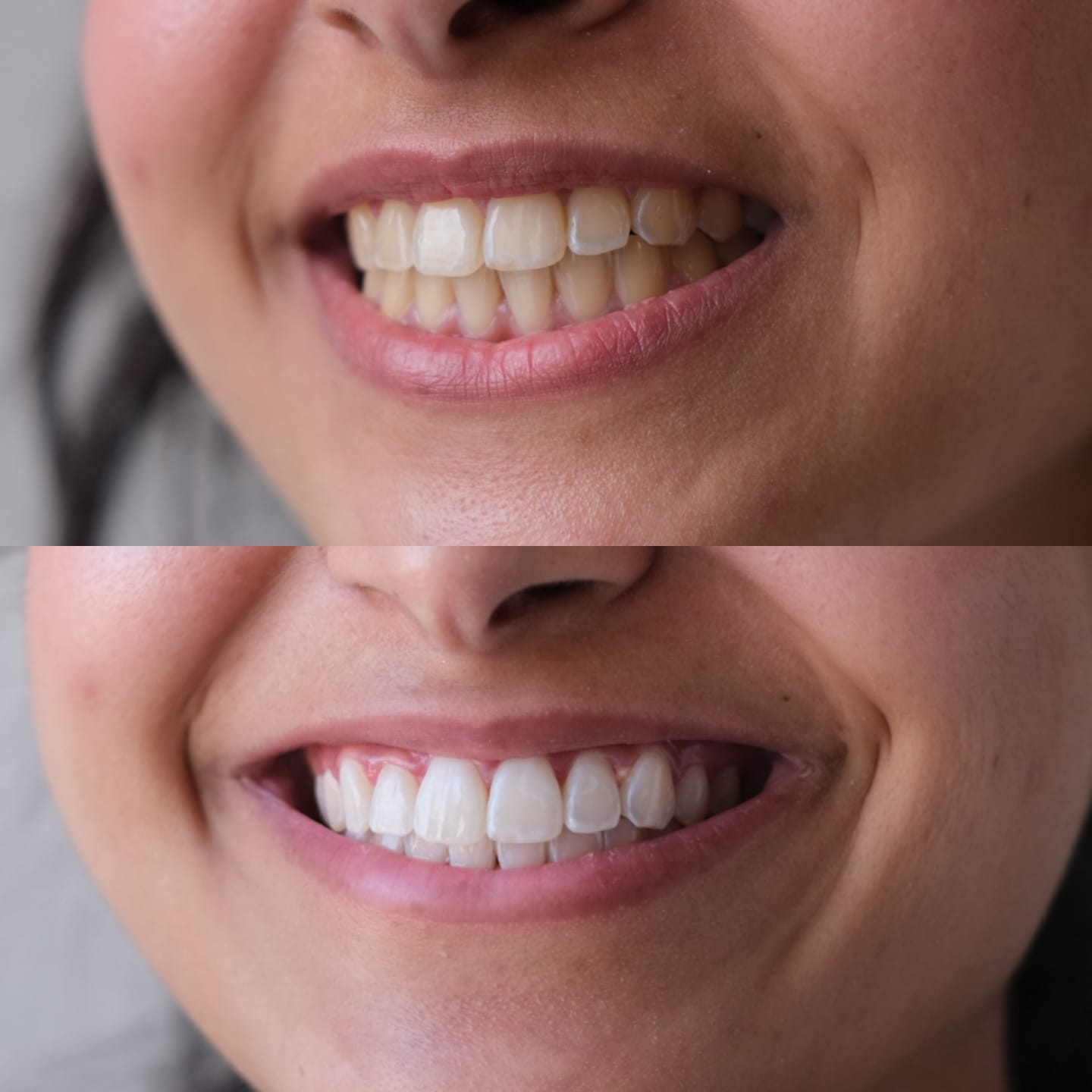Sourire avant et après traitement