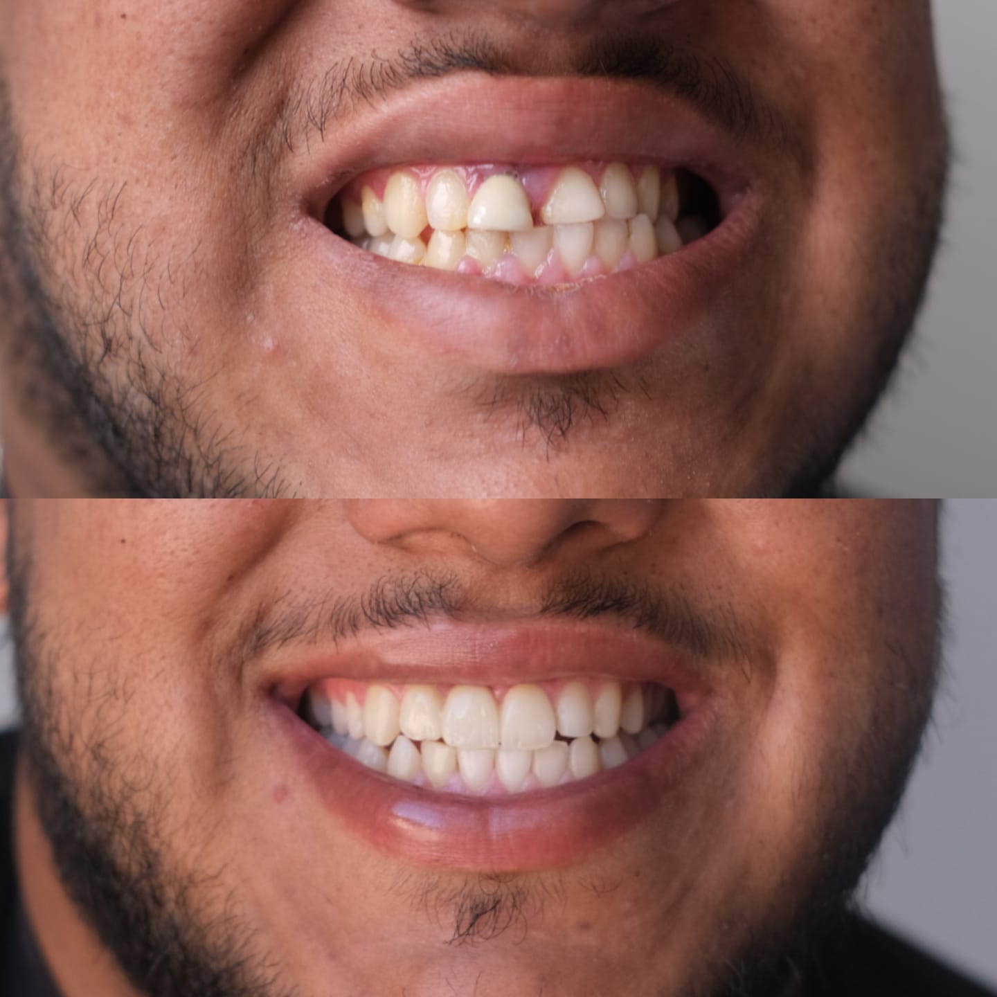 Sourire avant et après traitement